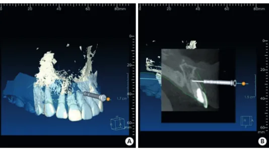 Figure 1. This figure demonstrates cone beam computed tomography (CBCT) data merged with STereoLithography  (STL) data obtained from scanning dental cast on implant planning software