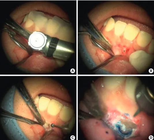 Figure 3. (A) Drilling with guide template placed. (B) After initial drilling, the position of targeting area can be  identified