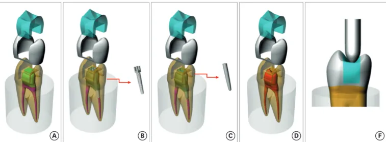 Figure 1. Schematic illustration of the modeled structures used in this study. The groups were distributed according to the restorative modality: (A) GIC group,  glass ionomer cement + composite resin; (B) MP group, metallic post + composite resin; (C) FGP
