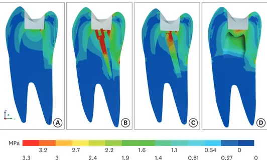 Figure 5. Results of maximum principal stress (MPa) in the root dentin and post according to the restorative  modality: (A) GIC group, glass ionomer cement + composite resin; (B) MP group, metallic post + composite resin; 