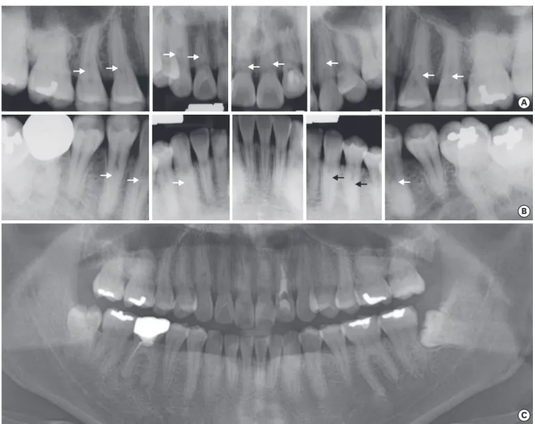 Figure 2. Periapical and panoramic X-rays of maxillary and mandibular teeth. (A) Dens invaginatus, in the maxillary incisors and the maxillary canines and  premolars present root canal calcification and/or pulp stones (arrows), (B) 6 anterior teeth and the