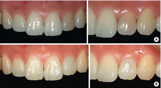 Figure 5. Postoperative intraoral photographs: (A) on the day of root canal obturation and placement of non-vital  bleaching agent to tooth #22, (B) a 6-month follow-up photograph showing color stability of tooth #22.
