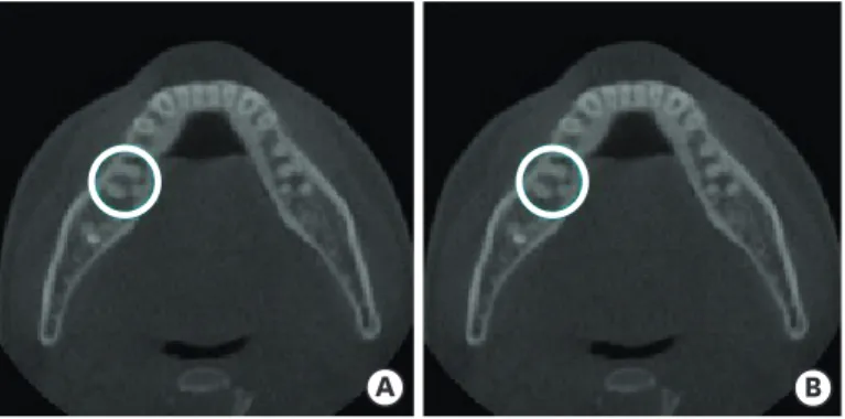 Figure 1. Representative cone-beam computed tomography images. (A) Mandibular first molar with the  morphology of 2 separate distal roots with 1 canal in each root (blue circle); (B) Mandibular first molar with the  morphology of 1 distal root with 2 separ