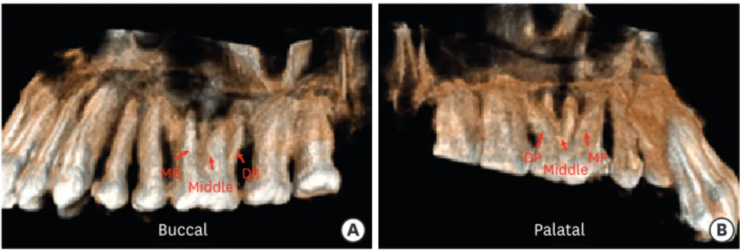Figure 2. (A) Three-dimensional single volume cone-beam computed tomography images showing the (A)  mesiobuccal, distobuccal, and middle root on the buccal aspect, and (B) mesiopalatal, distopalatal, and the  middle root from the palatal aspect