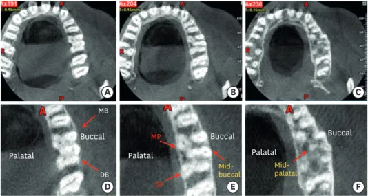 Figure 3. Cone-beam computed tomography (CBCT) images of tooth #26 showing the axial sections at the (A)  cervical, (B) middle, and (C) apical level