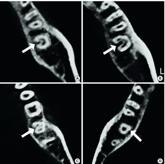 Figure 1. Classification of C-shaped canal systems using a modified version of Melton's method