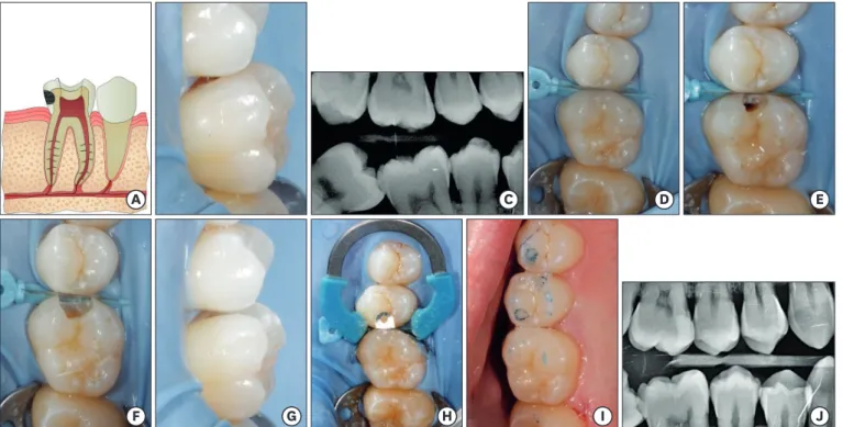 Figure 1. Scenario 1. (A) Diagram: supragingival caries does not reach the pulp. (B) Initial photography: caries cavity in molar tooth #16 does not invade the pulp  tissue or periradicular tissues