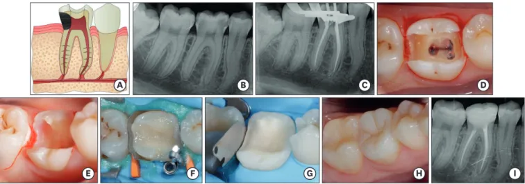 Figure 5. Scenario 5. (A) Diagram: caries with a margin in the junctional epithelium and reaching the pulp