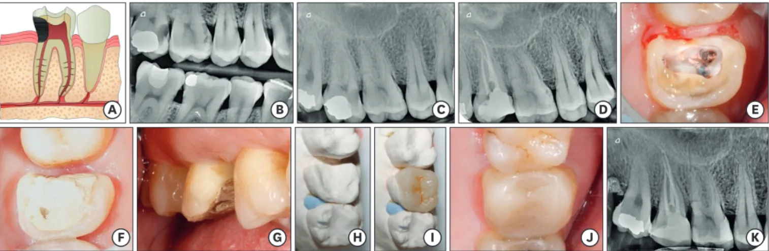 Figure 6. Scenario 6. (A) Diagram: caries invades the connective tissue and pulp. (B, C) Initial bitewing and periapical radiography, respectively; mesial caries  in tooth #17 under an amalgam filling