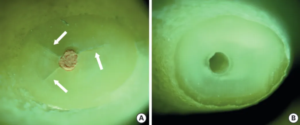 Figure 3. (A) New crack formation after root canal obturation (white arrows). (B) The sample without any crack  after root canal filling removal and apical enlargement