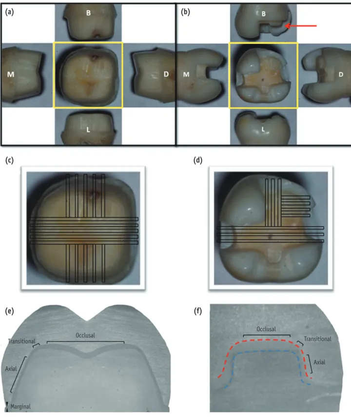 Figure 1. (a, b) Preparation design of nano-composite CAD/CAM restorations. (a) full crown and (b) mesio-occluso- mesio-occluso-distal inlay with a cusp capping; (c, d) Occlusal view from the yellow boxes of (a) and (b) were used to illustrate the  represe