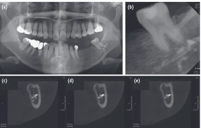 Figure 1. (a) Panoramic view of the patient after extrusion of calcium hydroxide. Increased radiopacity around periapical  area on left second molar; (b) Periapical view after canal cleaning and shaping; (c - e) On the cross sectional view of  CBCT, excess