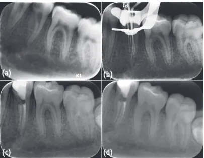 Table 1. Previous studies of mandibular second premolars with C-shaped root canals