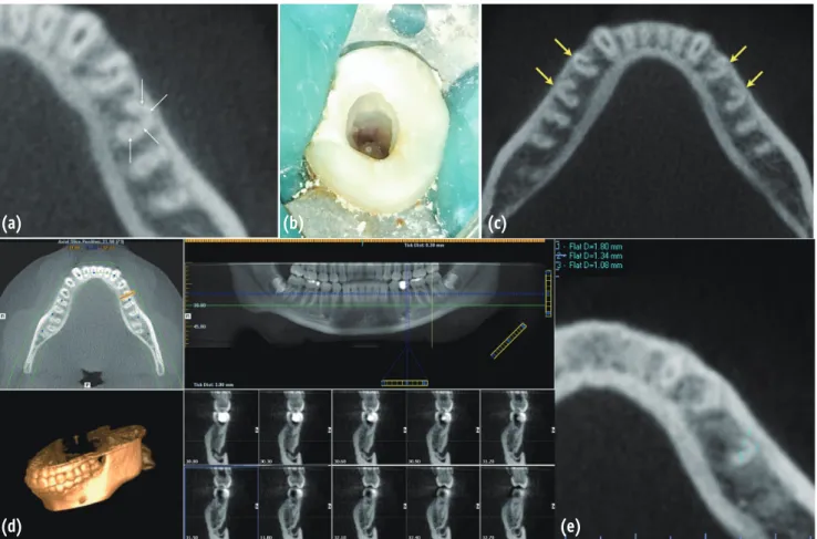 Figure 2. A CBCT scan and access cavity of the C-shaped left mandibular second premolar