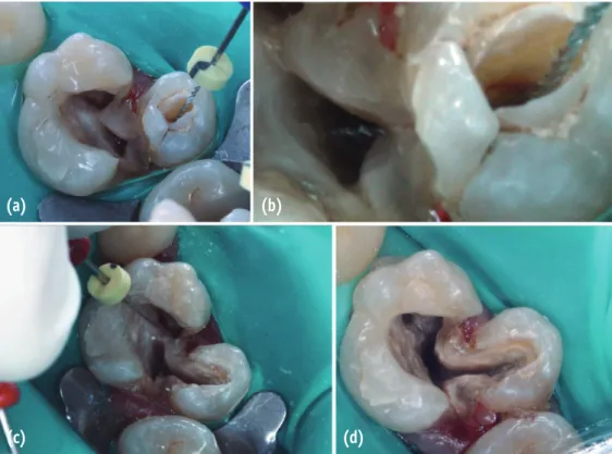 Figure 2. Complexity of anatomy. (a) Access cavities; (b) Communication between the canal systems of the molar and  premolar; (c) Fusion between distobuccal and palatal canals; (d) The remaining two canals after shaping.