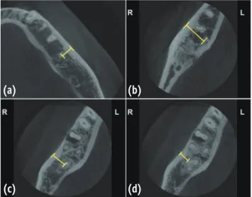 Figure 1. Mandibular axial cone beam computed  tomography (CBCT) images for measurement