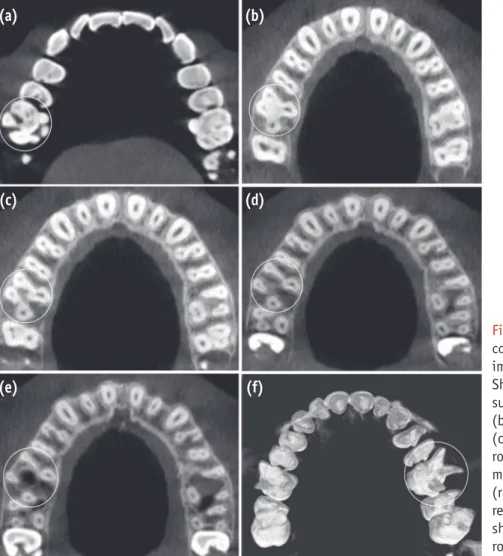 Figure 3. Axial section of  cone-beam  computed tomography (CBCT)  scan  images of tooth #16 (a - e)