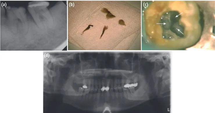 Figure 1. At initial visit, the patient complained of spontaneous throbbing pain in tooth #36
