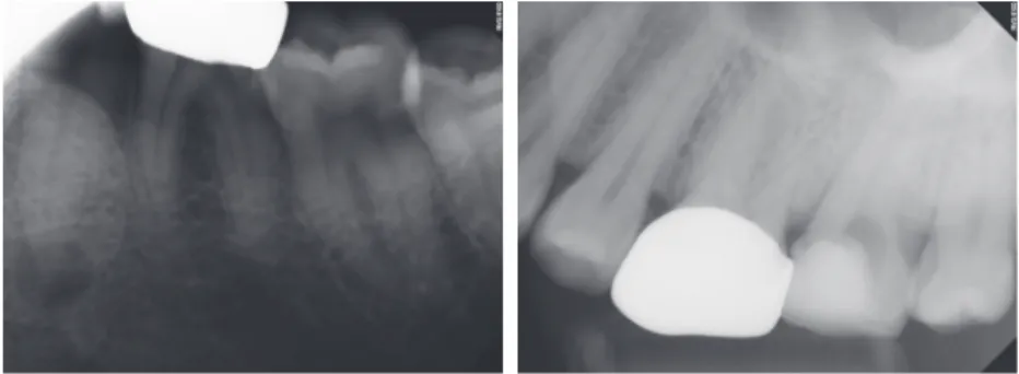 Figure 5. Clinical photographs during the surgical procedure. (a) Flap elevation, extraction of teeth #34 and 35,  decortication, and saucerization; (b) Suture; (c) Panoramic radiograph film after surgical procedure.