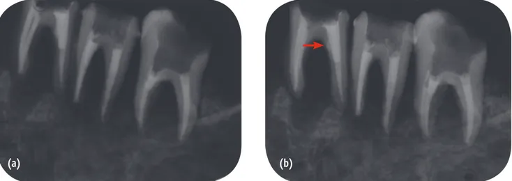 Figure 2. Periapical radiography taken with conventional intraoral (CI) imaging technique