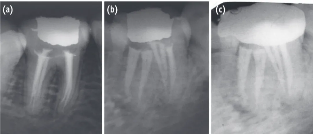 Figure 4. Post obturation radiographs. (a) Straight on angulation; (b) Distal angulation; (c) 6 month follow up