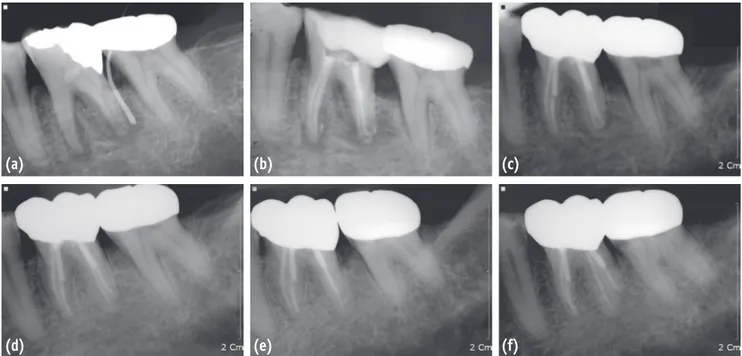 Figure 1. A series of periapical radiographs of the mandibular left first molar of case 1