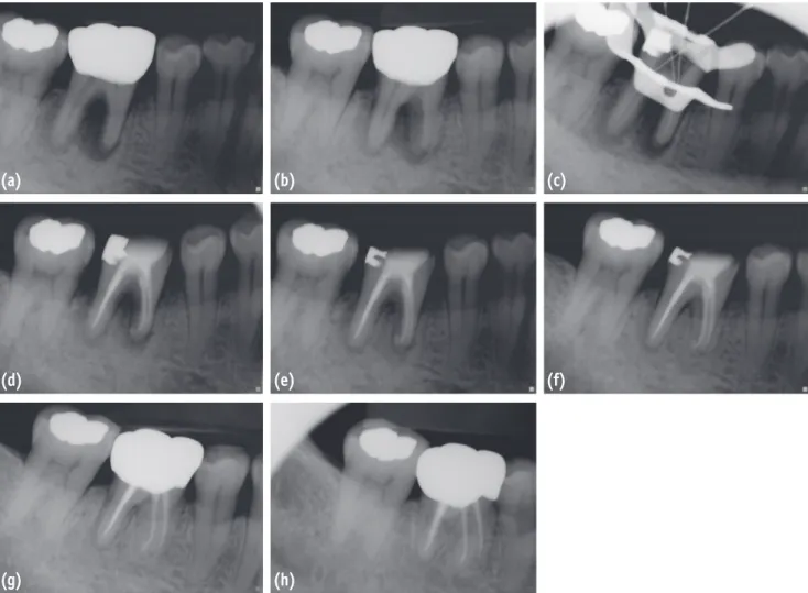 Figure 2. Periapical radiographs of case 2. (a) A preoperative periapical radiograph showed a J-shaped radiolucency on  the mesial root of mandibular right first molar; (b) A preoperative radiograph with a different horizontal angle