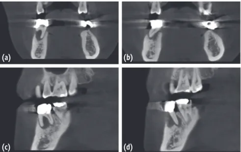 Figure 3. Preoperative views of #46 of case 2 using cone-beam computed tomography (CBCT)
