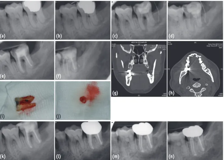 Figure 4. A series of periapical radiographs, computed tomographic (CT) views, and clinical photos of the mandibular  left second molar of case 3