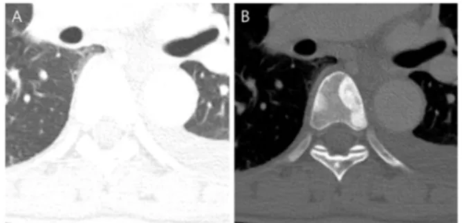 Fig.  2.  Two  example  of  the  osteoblast  metastasis  lesions  according  to  window  setting  in  CT  images,  (A)Lung  window  setting,  (B)Bone  window  setting