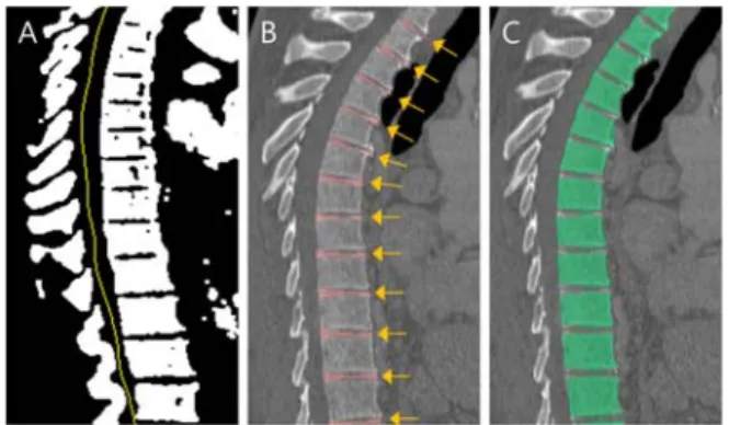 Fig.  7.  Two  concepts  of  the  detection  algorithm  on  vertebral  body,  (A)  boundary  detection  (B)  disk  segmentation 중심선  검출  후,  1  차적으로  추체  영역을  분할한 다