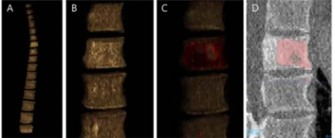 Fig.  10.  Three-dimensional  visualization  of  bone  metastatic  lesions,  (A)Segmented  vertebral  body,  (B)Volume  rendering,  (C)Bone  metastasis  lesions  on  the  rendered  data(B),  (D)The  corresponding  regions  of  (C)  on  CT  image