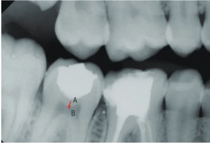 Figure 1. (a) Preoperative; (b) After caries excavation; (c)  PAD solution application; (d) PAD light application.