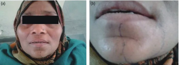 Figure 1. Area of paresthesia on the first visit.