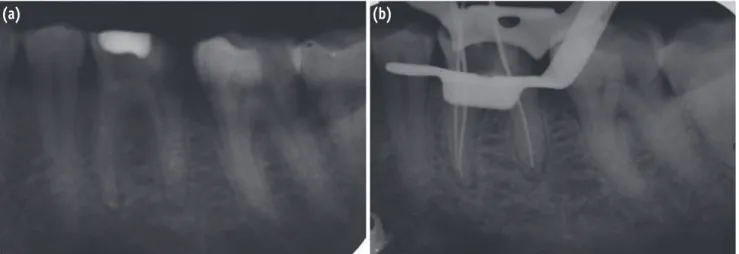 Figure 2. (a) Pre-operative Radiograph; (b) Working length radiograph.