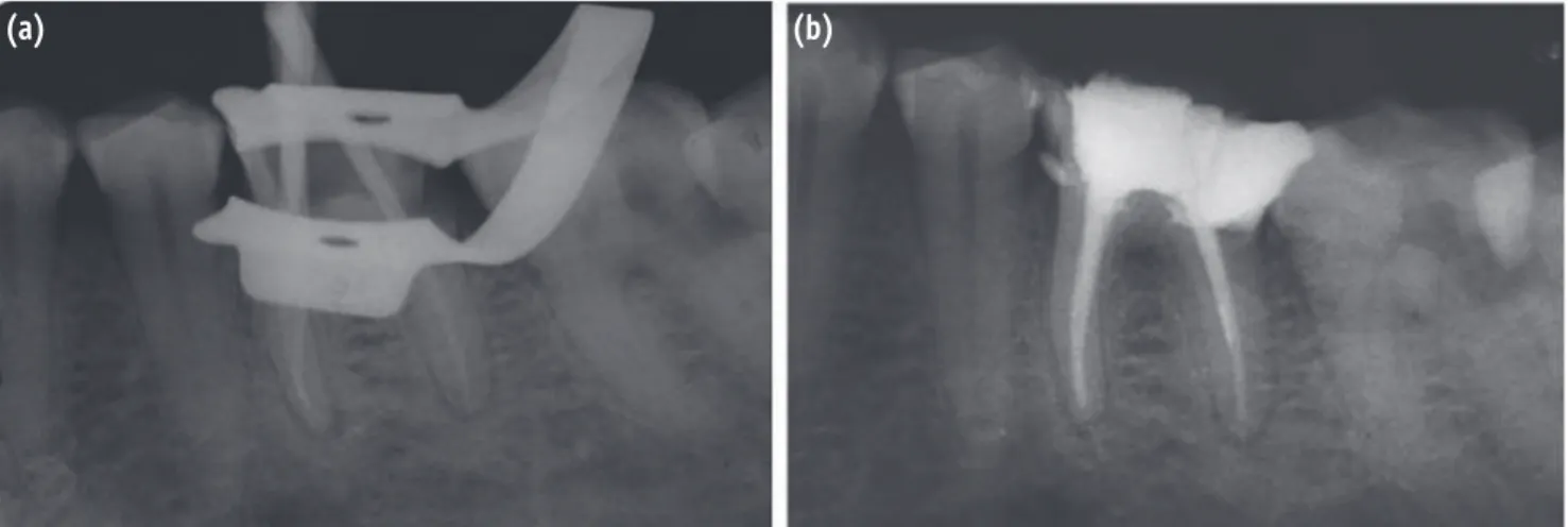 Figure 5. (a) Master cone radiograph; (b) Post-obturation radiograph.