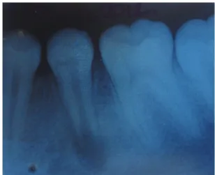 Figure 2. Immediate post-operative periapical radiograph  of the left permanent mandibular second premolar.