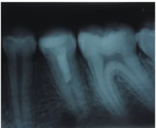 Figure 3. Periapical radiograph of the left permanent 