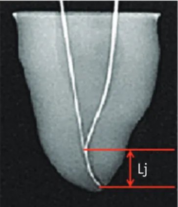 Figure 1. The distance between the file tip and merging  point of two joining canals (Lj) on radiograph.