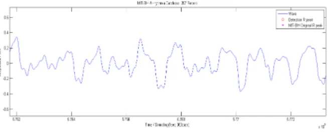 Fig. 3.    Ventricular  fibrillation  waveform