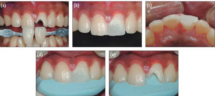 Figure 3. Putty index fabrication. (a) Shade matching; (b) Build-up with temporary filling material, labial view; (c) Build- Build-up with temporary filling material, palatal view; (d) Putty impression for palatal wall; (e) Checking index after removal of 