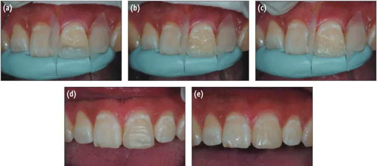 Figure 8. Composite resin build-up using Natural layering technique. (a) After tooth isolation, enamel resin was applied  to establish palatal and proximal walls; (b) and (c) Artificial dentin was applied; (d) Final enamel resin was applied; (e)  After fin