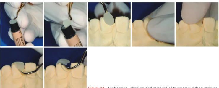 Figure 11. Application, shaping and removal of temporary filling material.