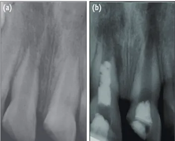 Figure 1.  Preoperative (a) and immediately postoperative  (b) radiographs of maxillary central incisors