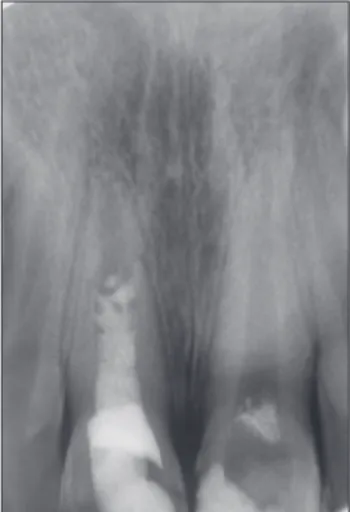 Figure 2.  12-month follow-up radiography. Figure 3.  At 18-month postoperative radiography, continued  root maturation of both teeth and resolution of the 