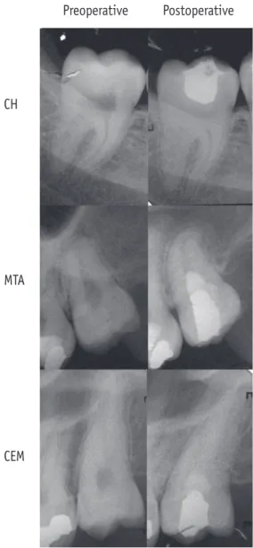 Figure 1. Preoperative and postoperative periapical  radiographs of clinically erupted third molars; 