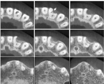Figure 1. (a) Clinical view of maxillary lateral incisor  showing cervical non-carious defect; (b) Radiographic  view of dens invaginatus