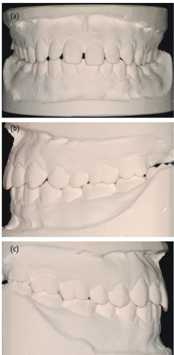 Figure 1. Preoperative photograph. Note the unevenly  distributed interdental spaces among maxillary anterior  teeth and midline deviation of 2 mm to right side of  max-illary arch.
