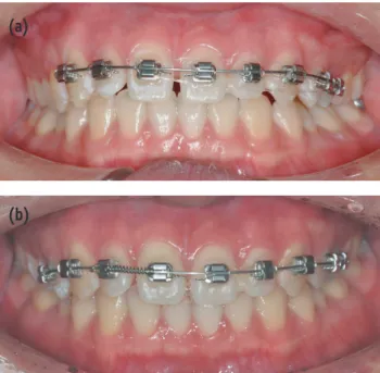 Figure 3. Two different diagnostic wax-ups. (a) Direct  composite build-ups only; (b) Direct composite build-ups  combined with orthodontic tooth movement.