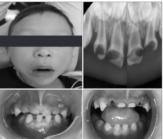 Fig. 1. Extraoral photo, periapical x-ray  image of maxillary anterior teeth before  treatment (upper), intraoral photo of  be-fore and after treatment (lower)